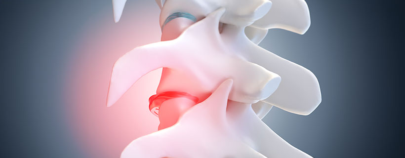 patient needing degenerative disc disease in need of spinal decompression therapy in Monroeville