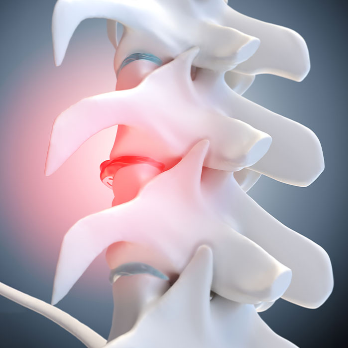 degenerative Disc Disease treatment in Monroeville