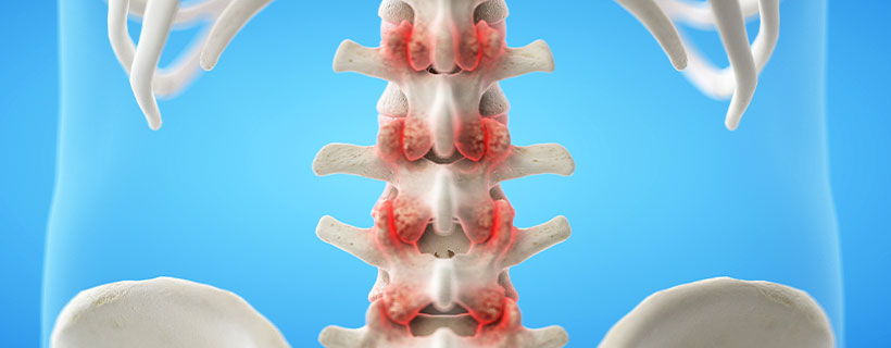 patient needing facet joint syndrome in need of spinal decompression therapy in Monroeville