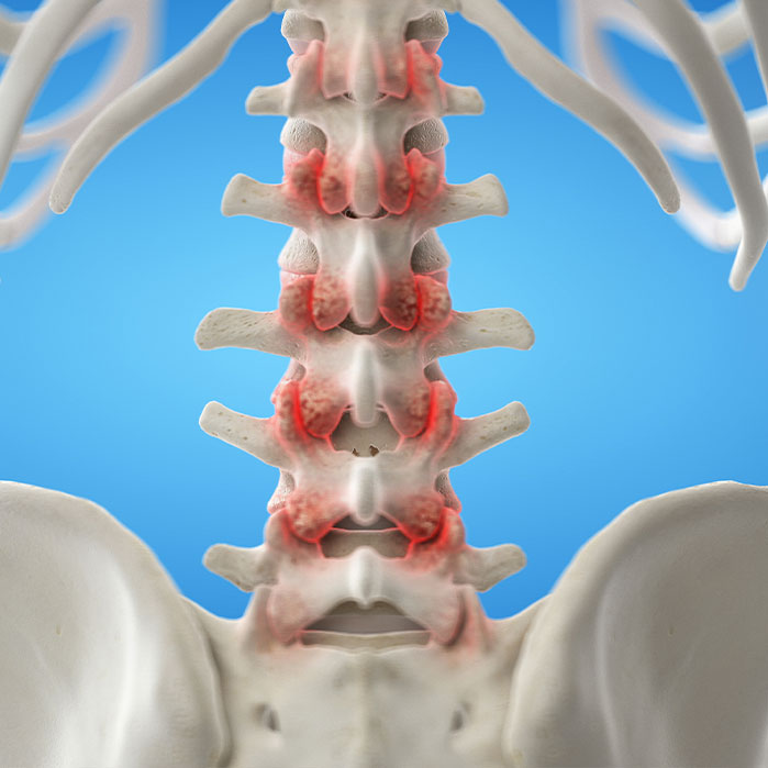 facet Joint Syndrome treatment in Monroeville