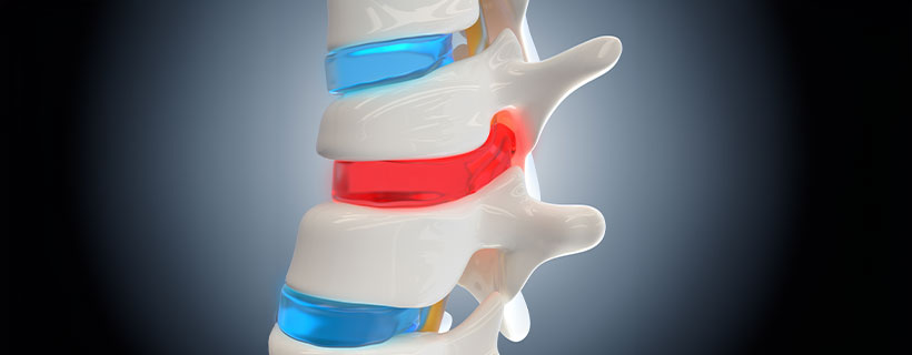 patient needing herniated disc in need of spinal decompression therapy in Monroeville