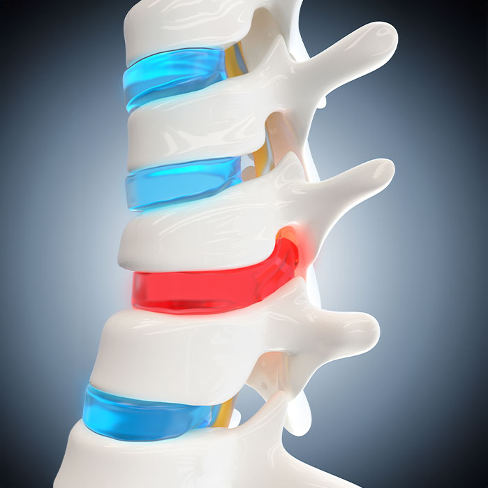 herniated Disc treatment in Monroeville