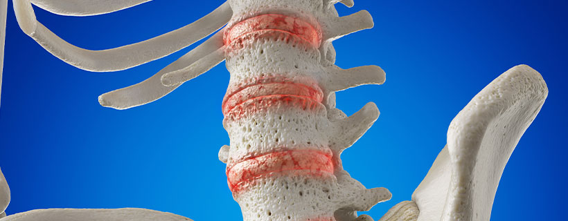 patient needing osteoarthritis in need of spinal decompression therapy in Monroeville