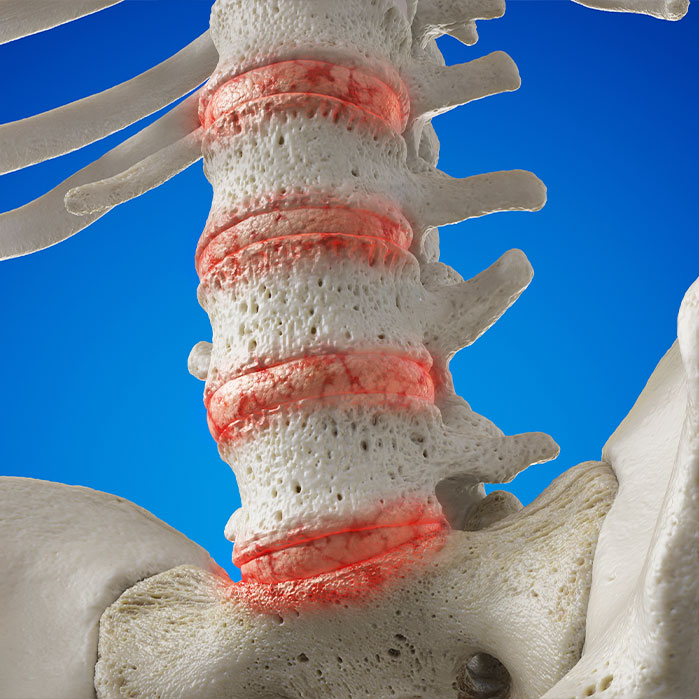 osteoarthritis treatment in Monroeville
