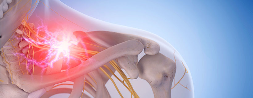 patient needing pinched nerve in need of spinal decompression therapy in Monroeville