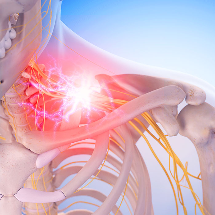 pinched nerve treatment in Monroeville