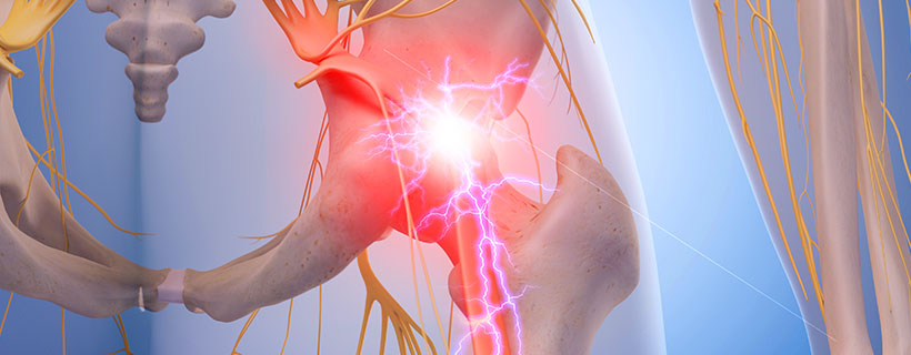 patient needing sciatica in need of spinal decompression therapy in Monroeville