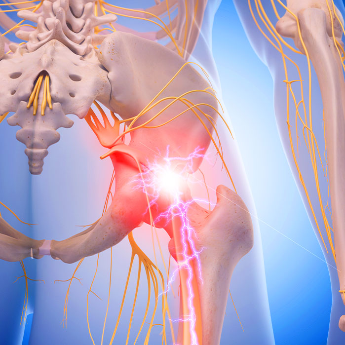 sciatica treatment in Monroeville