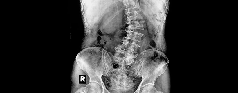 patient needing scoliosis in need of spinal decompression therapy in Monroeville