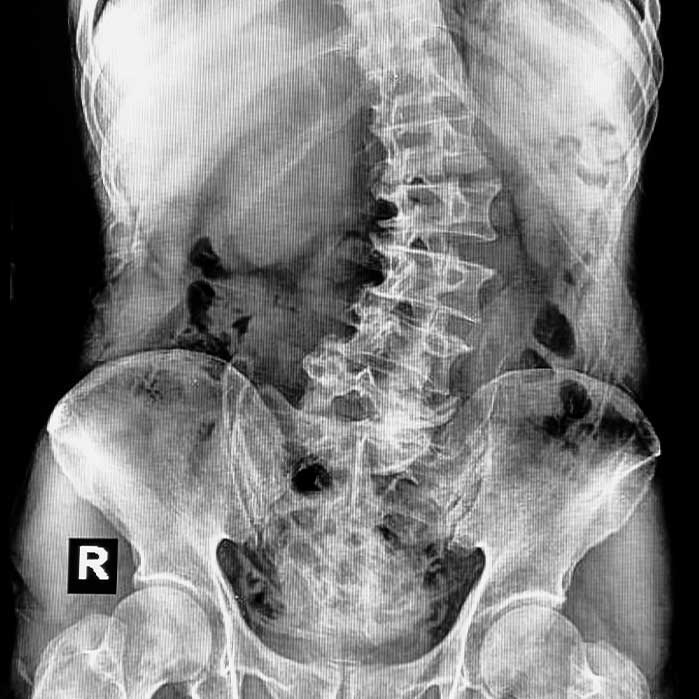 scoliosis treatment in Monroeville