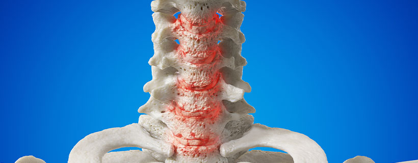 patient needing spondylosis  in need of spinal decompression therapy in Monroeville