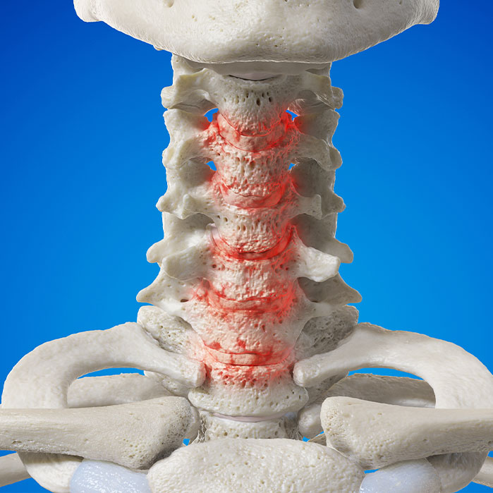 spondylosis treatment in Monroeville